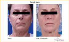 Botox voor een mooie en strakke huid; hoe werkt dat eigenlijk?