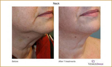 Nu is het moment: peel it off bij Schoonheidscentrum Appels