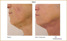 De zes meest gestelde vragen over Dermatude Meta Therapy