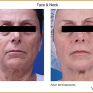 Botox voor een mooie en strakke huid; hoe werkt dat eigenlijk?